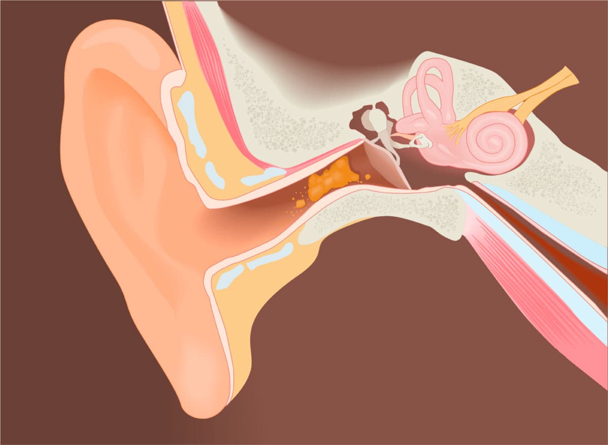 Quitar tapón de oído en Cee, Lalín y Ordes
